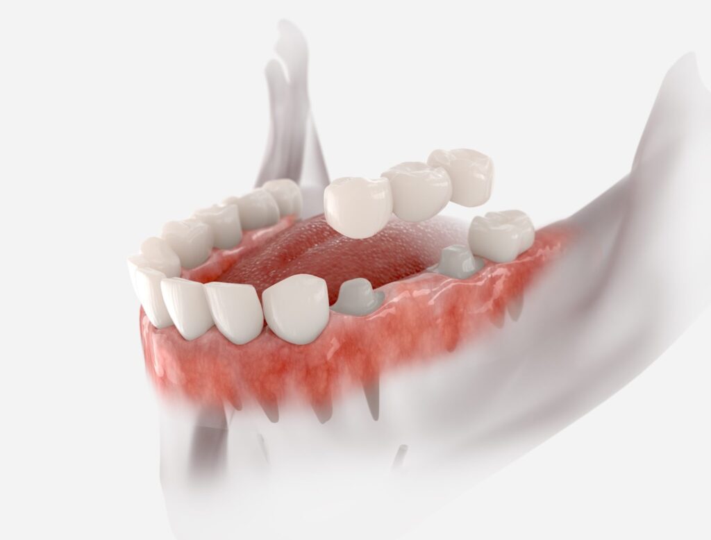 dental bridge