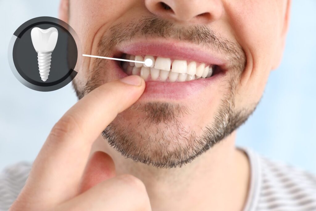 dental-implant