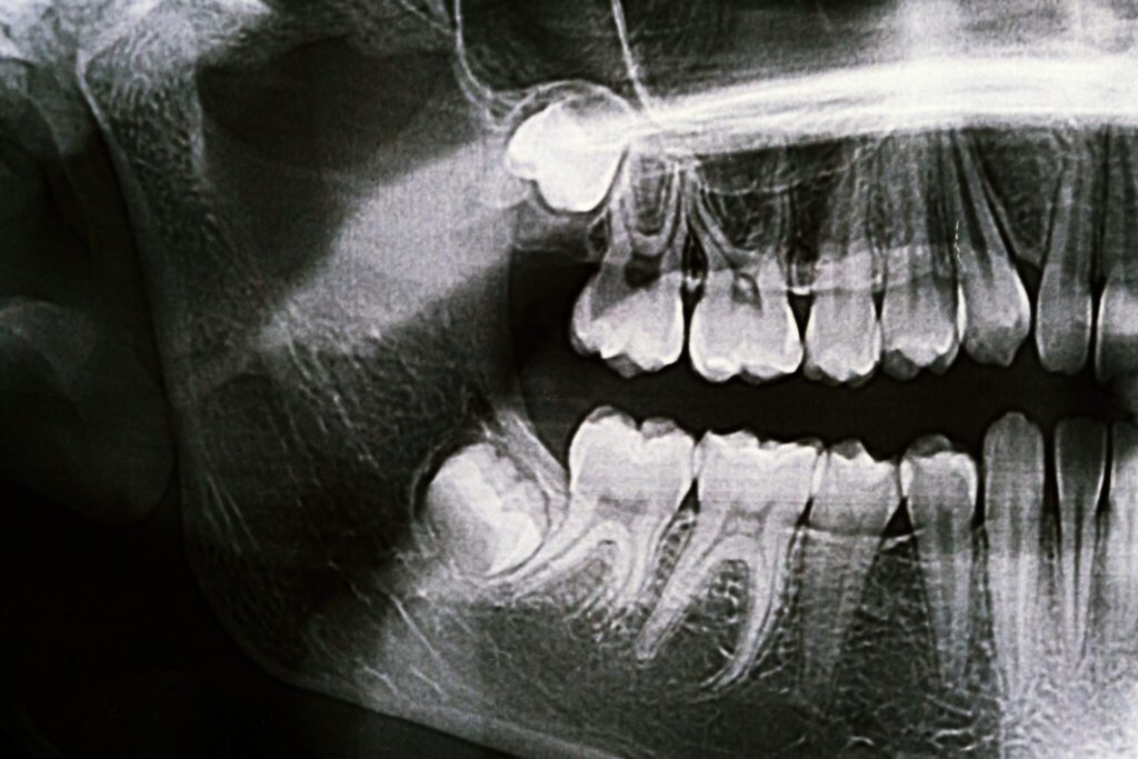 wisdom-teeth-xray